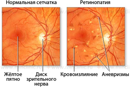 ретинопатия